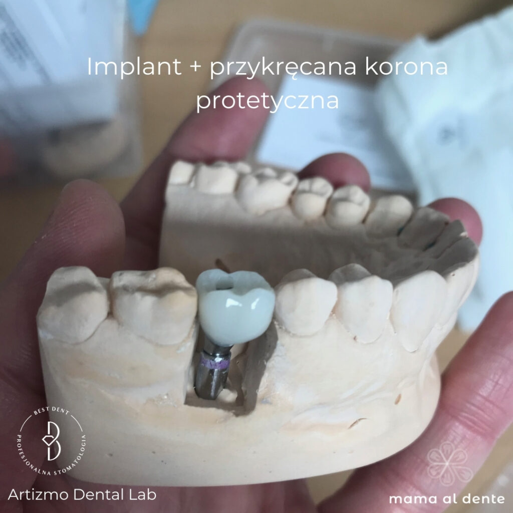 Implant+korona porcelanowa