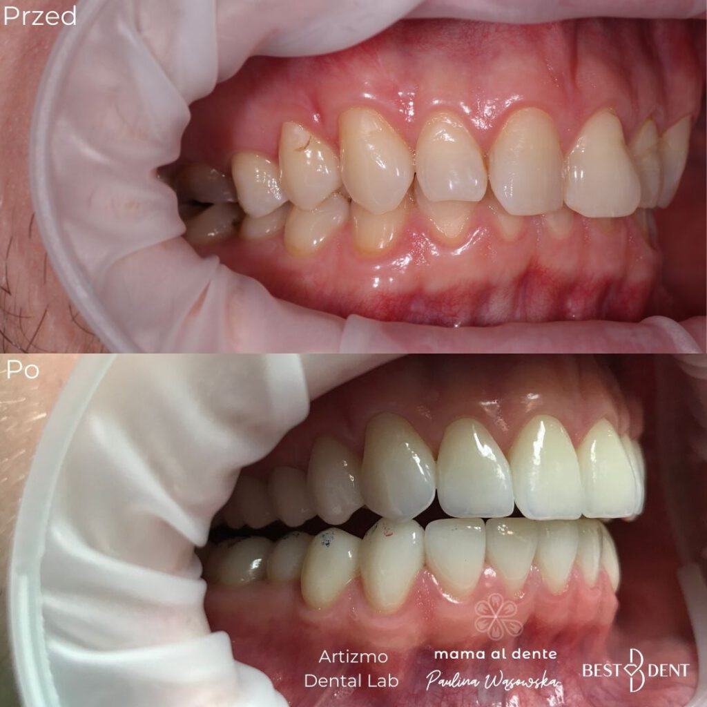 Zęby przed i po leczeniu, licówki porcelanowe