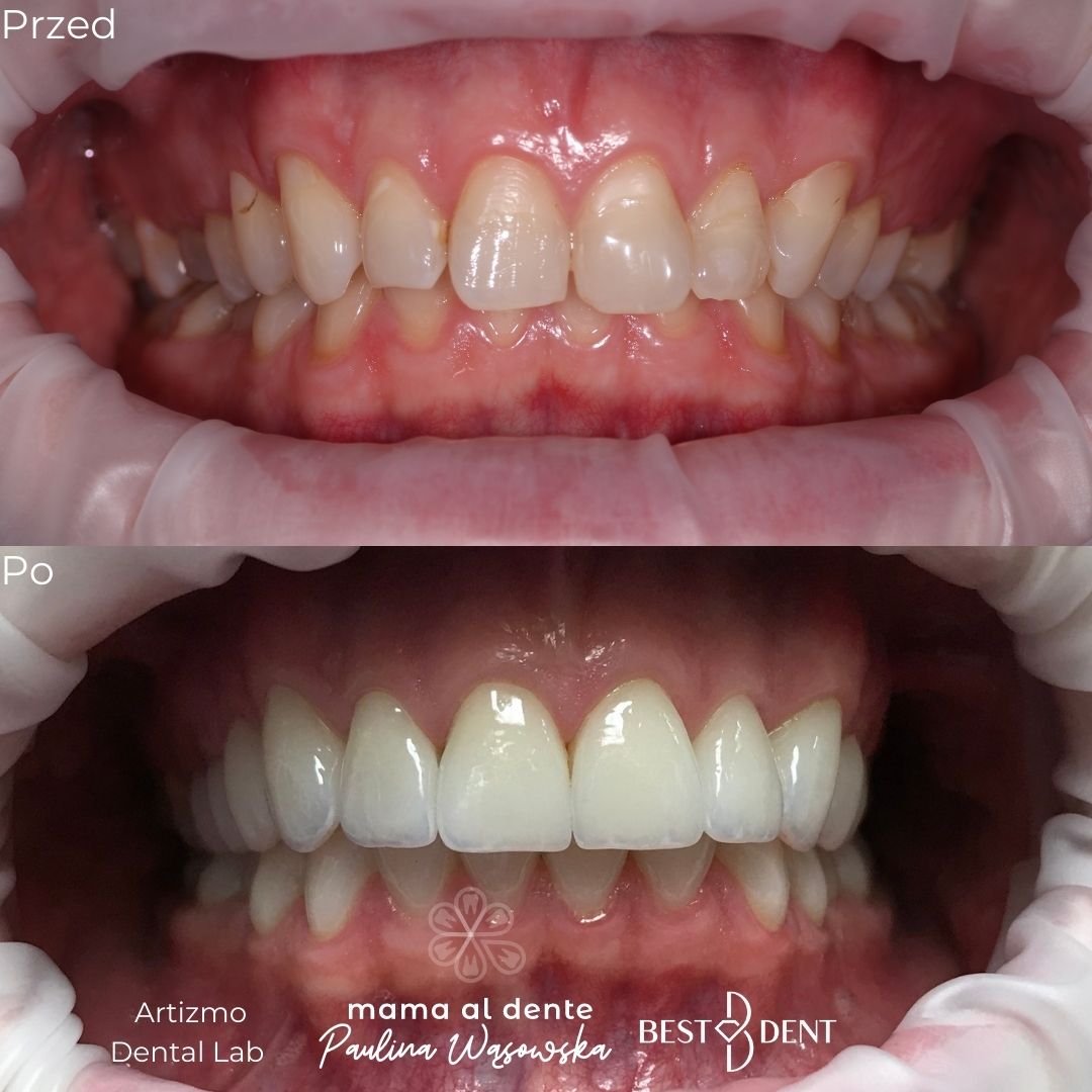 Zęby przed i po leczeniu, licówki porcelanowe