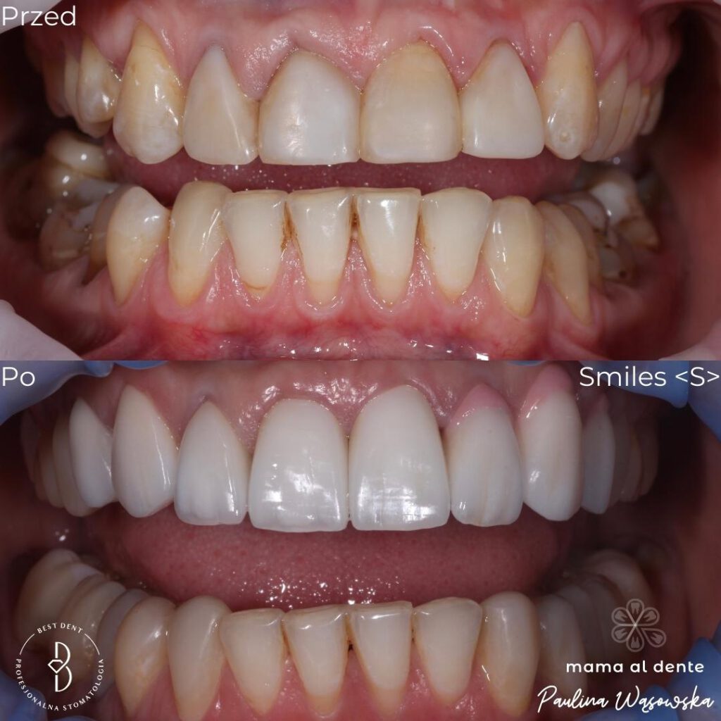 Uzębienie przed i po leczeniu protetycznym, korony porceanowe na przednich górnych zębach, dolne zęby odbudowane za pomocą kompozytu