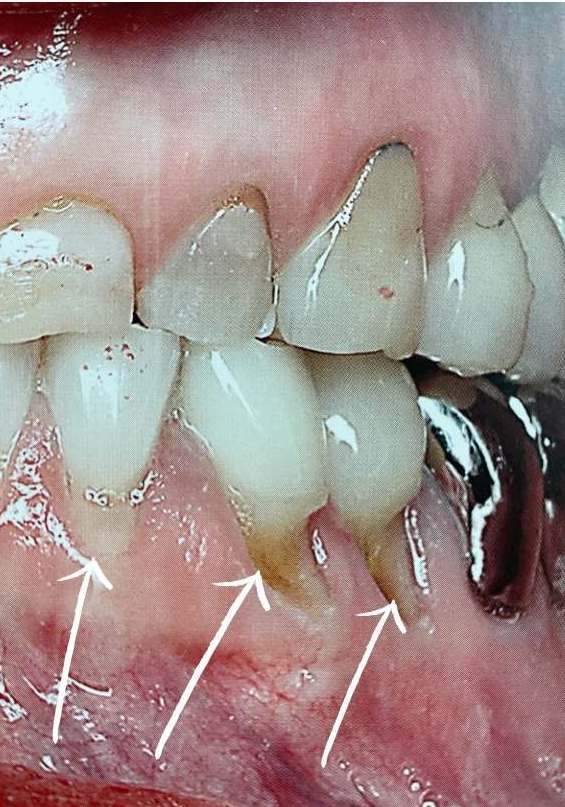 Ubytki klinowe zębów