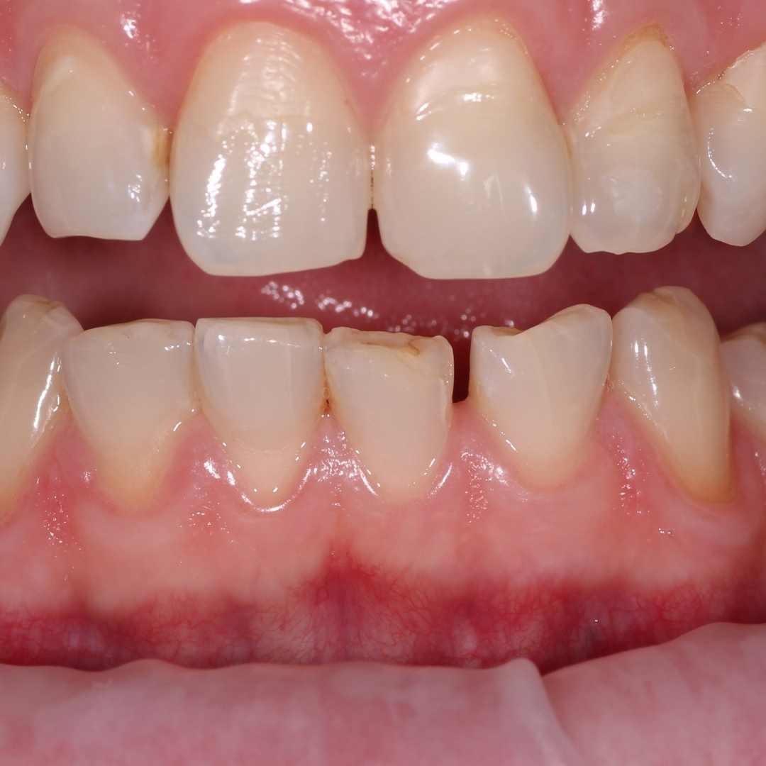 Starcie patologiczne zębów, starte zęby