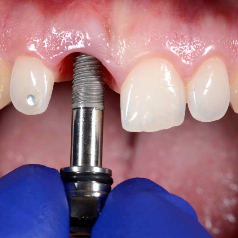 Dla kogo są implanty zębowe?